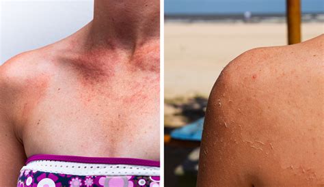 Protecting Your Skin From Sun Damage Exploring Medications And Their