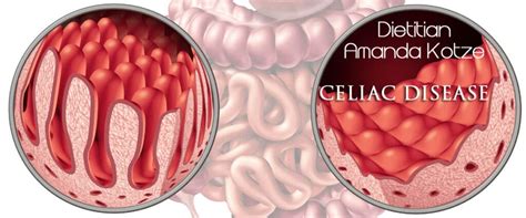 Celiac Disease Vs Non Celiac Gluten Sensitivity Metabolica Med Pty Ltd