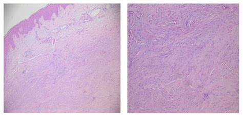 Jcm Free Full Text Nodular Keloidal Scleroderma With No Systemic