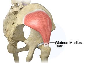 Gluteus Medius Tear Adelaide, Henley Beach | Gluteus Medius Injuries ...