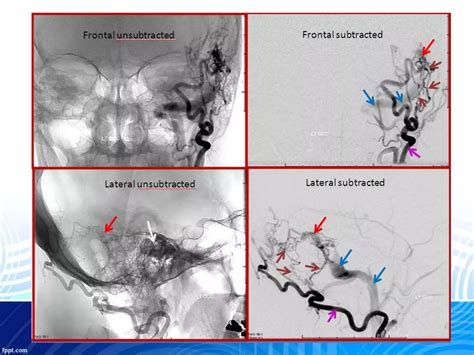 Dural Arteriovenous Fistula And Avm Ppt