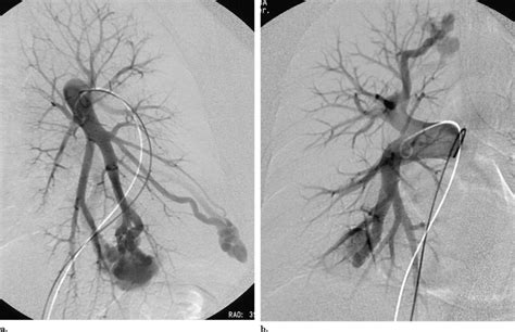 Bilateral Multiple Pulmonary Arteriovenous Malformations Endovascular