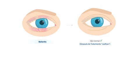 Ojo Seco Y Blefaritis Dos Problemas Muchas Veces Relacionados