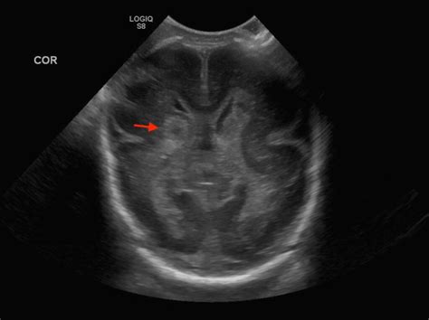 Germinal Matrix Hemorrhage Grade 1