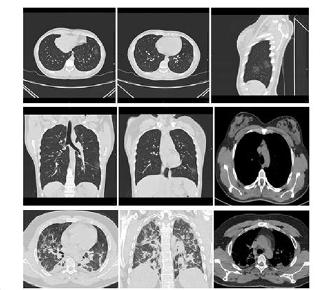 Ct Scan Shows Two Rounded Lobular Ground Glass Opacity Ggo Affecting Download Scientific