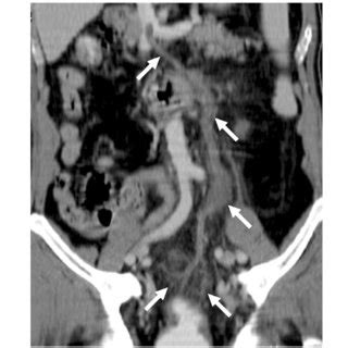 IMV Thrombosis A 70 Year Old Man Presented To ED With Severe Melena