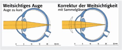 Kontaktlinsen Bei Weitsichtigkeit Avermann Contactlinsen