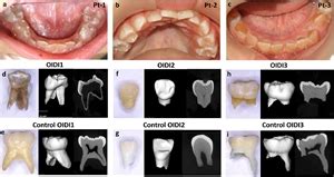 Dentinogenesis imperfecta | News | Dentagama