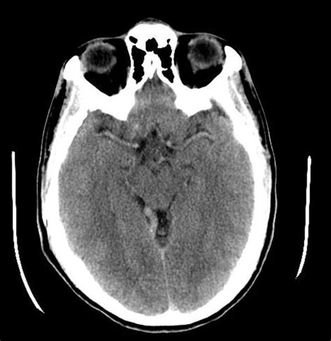 Developmental venous anomaly - wikidoc