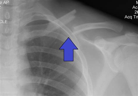 Clavicle Fracture Peds Wikem