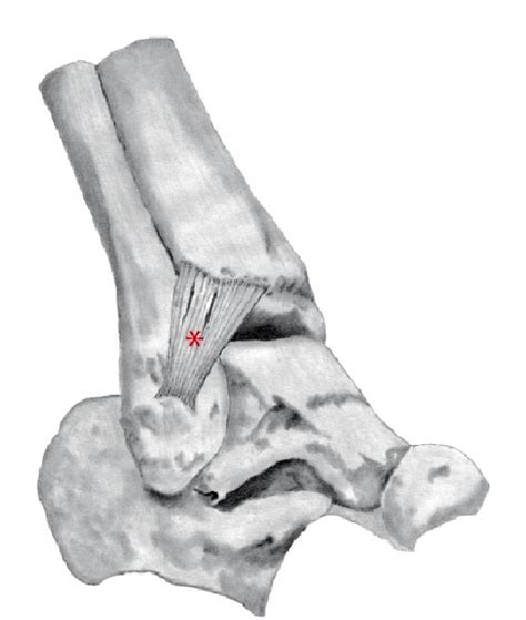 Figure 1 From Cadaveric Analysis Of The Distal Tibiofibular Syndesmosis