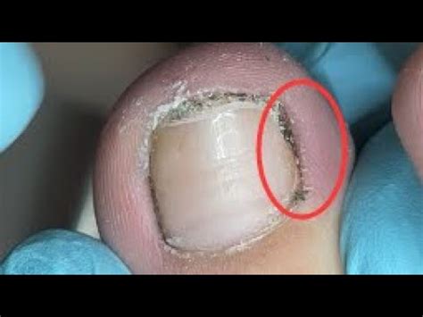 Best Toenail Dirt Cleaning Youtube