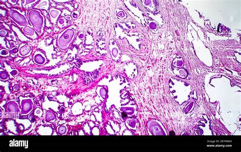 Histopathology Of Prostate Gland Hyperplasia Light Micrograph Photo