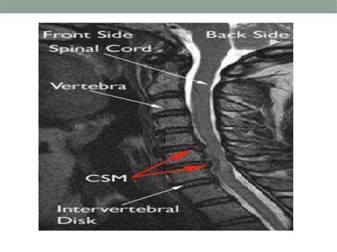 Spastic paraplegia