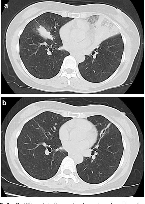 Figure From Allergic Bronchopulmonary Aspergillosis Presenting With