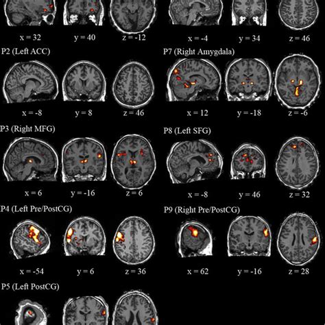 Eeg Informed Fmri Analysis In An Auditory Choice Reaction Task A Eeg