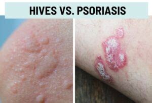 Hives Urticaria Vs Rash Pictures And Differences