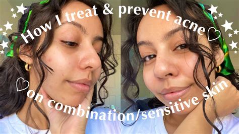 Acne Struggles Tips And Tricks To Treat And Prevent Acne On