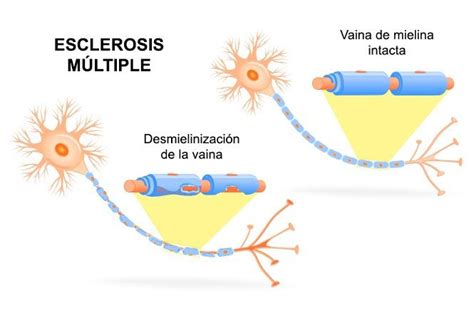 La Mielina En Las Neuronas Qué Es Y Cuál Es Su Función