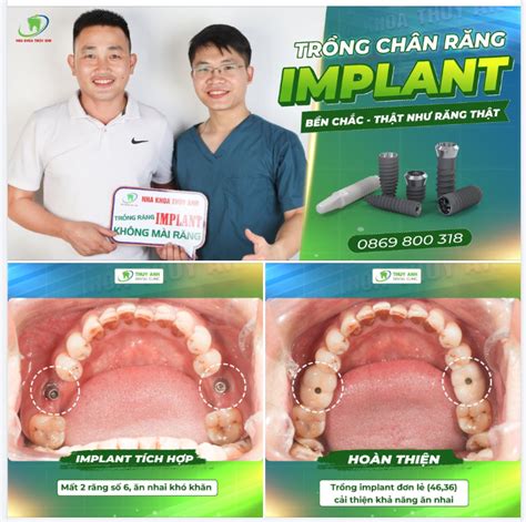 HOÀN THIỆN 2 RĂNG IMPLANT SỐ 6 CHO ANH KHÁCH HÀNG TẠI NHA KHOA THÙY ANH