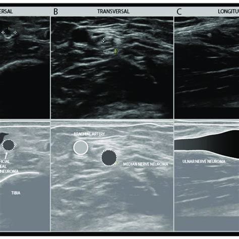 Examples Of Traumatic Neuroma In Continuity Transverse View Of A Small