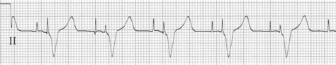 Pacemaker Rhythms Normal Patterns • Litfl • Ecg Library Diagnosis