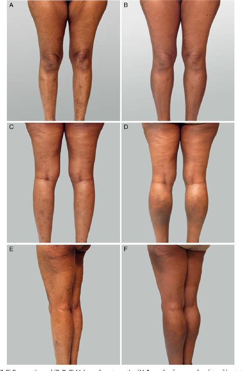 Figure From Calf Augmentation And Reshaping With Autologous Fat