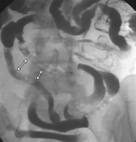 Ct Findings Of Acute Small Bowel Entities Radiographics