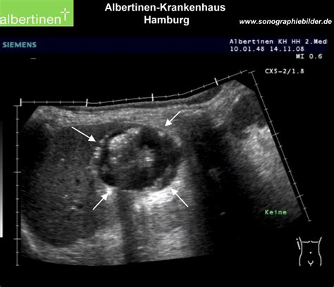 Leberabszess DocCheck Flexikon