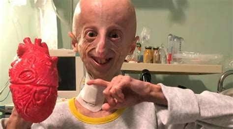 Progeria los pasos de los últimos 20 años muestran cierta esperanza