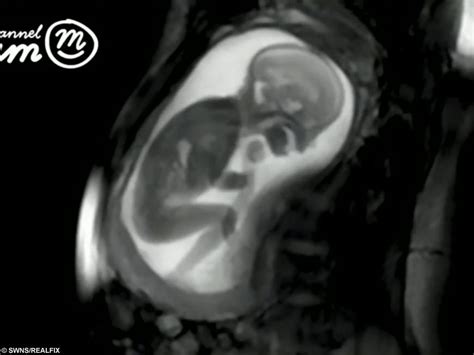 Baby Mri Scan Results Get More Anythinks