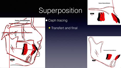 Ethnicity and premolar extraction - Dr. Sylvain Chamberland, Orthodontist