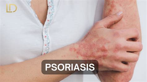 Psoriasis Causes Symptoms And Treatment Options