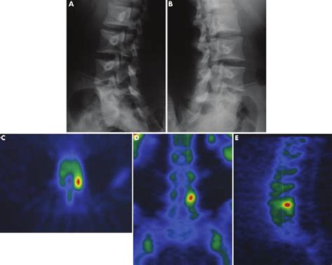 Right Unilateral Developing Spondylolysis At L5 A And B 45 ̊ Download Scientific Diagram