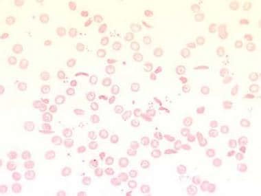 Hemoglobin Sc Disease Blood Smear