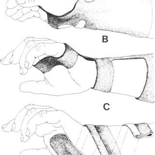 Dorsal Blocking Splint PDF Thumb Hand, 40% OFF