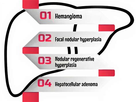 Most Common Benign Tumors of The Liver - A2Z Healthy