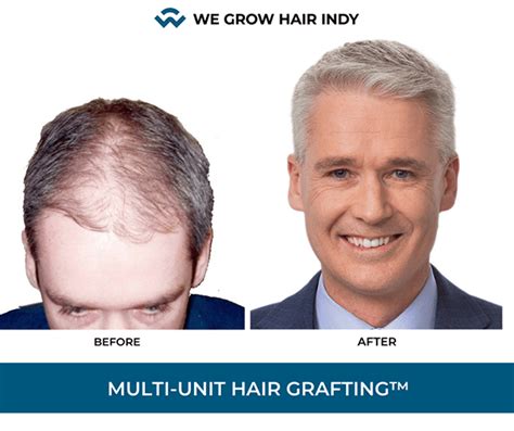 Five Things You Should Know About Hair Transplants We Grow Hair Indy