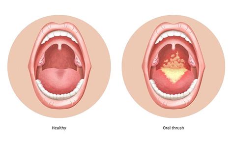 10 Signs and Symptoms of Oral Thrush