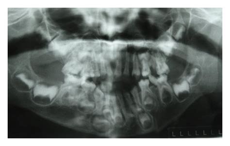 Amelogenesis Imperfecta Radiograph