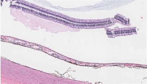 Eye Retina Choroid And Sclera Nus Pathweb Nus Pathweb