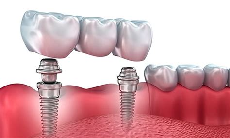 Puentes Dentales Son Mejores Que Los Implantes Limpieza Dental