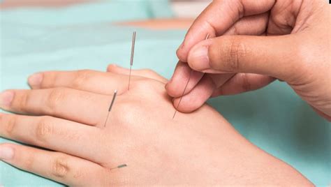 Arthritis Acupuncture Adelaide Af Health Acupuncture