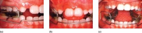 Figure 4 From Pseudo Class Iii Malocclusion Treatment With Balters’ Bionator Semantic Scholar