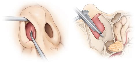 Cirugía Transesfenoidal Cirujano Experto Aaron Cohen Gadol Md