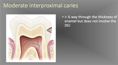 Chapter 33 Interpretation Of Dental Caries Flashcards Quizlet