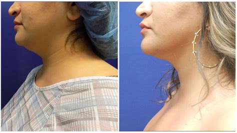 Double Chin Liposuction End To End Guide Bellezie