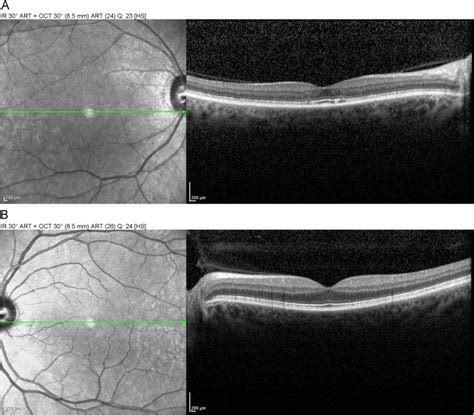 Unilateral Manifestation Of Autoimmune Retinopathy Canadian Journal Of Ophthalmology