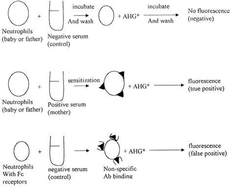 Neonatal Alloimmune Neutropenia Due To Anti Hna 1b Annals Of Saudi