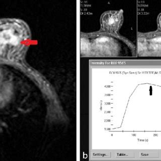 Axial Post Contrast T 1 Weighted Image A Of Bilateral Breasts